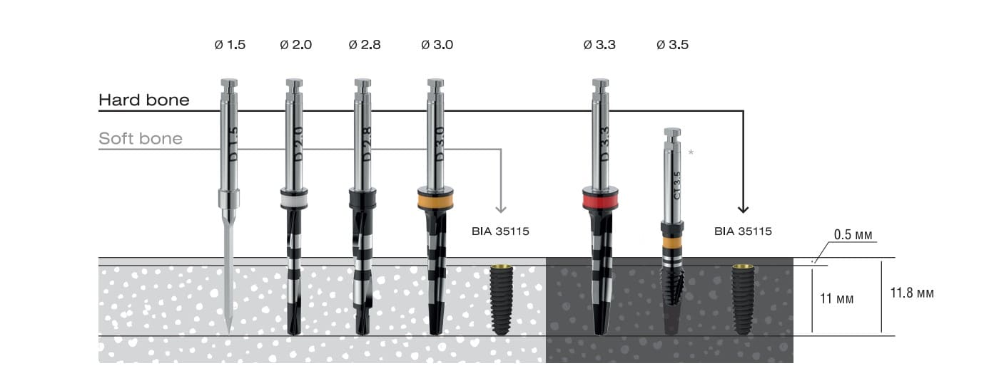 Asper installation protocol with a diameter of 3.5 mm