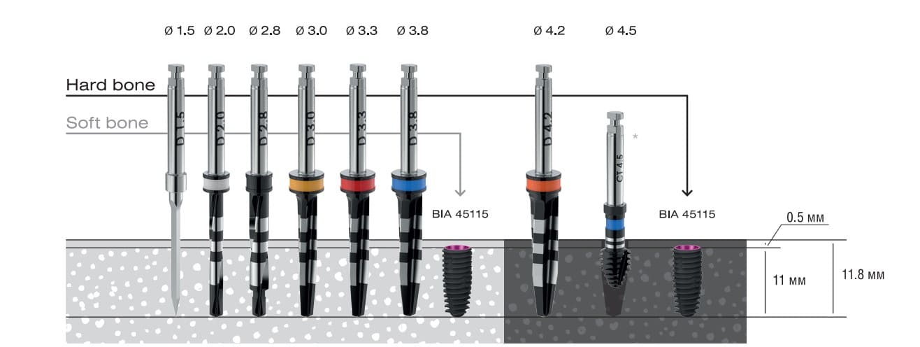 Asper installation protocol with a diameter of 4.5 mm