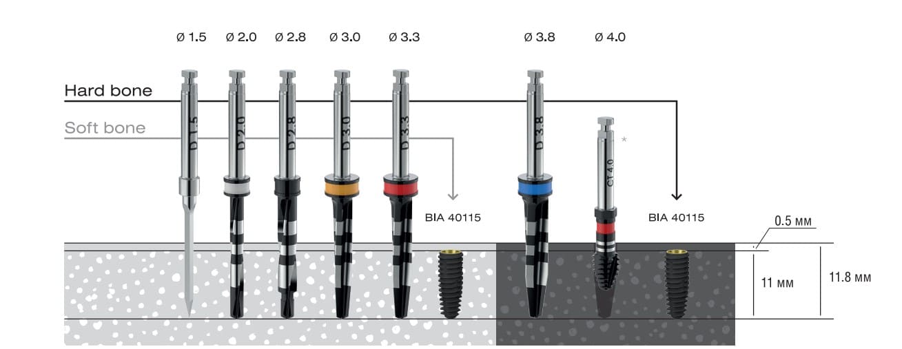 Asper installation protocol with a diameter of 4 mm