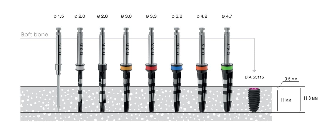 Asper installation protocol with a diameter of 5.5 mm