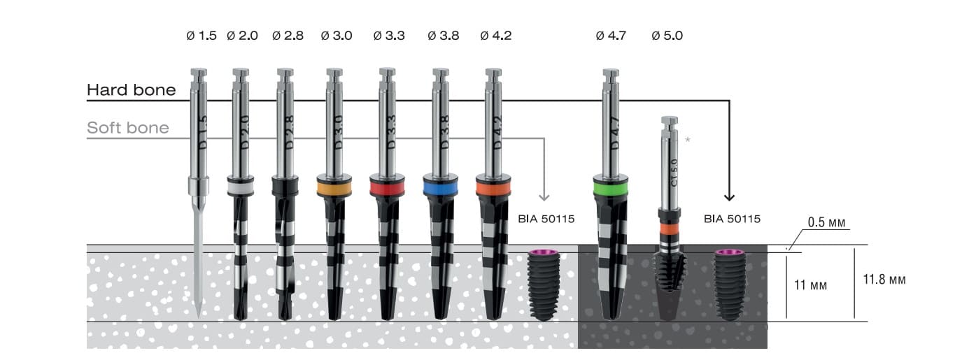 Asper installation protocol with a diameter of 5 mm