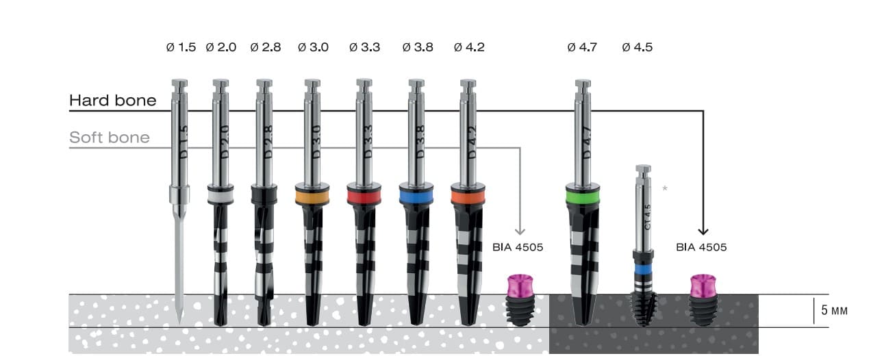 Asper 5 mm installation protocol with a diameter of 4.5 mm