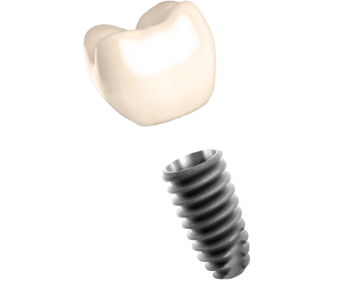 Buy a HELIX implant and get a zirconium crown for free